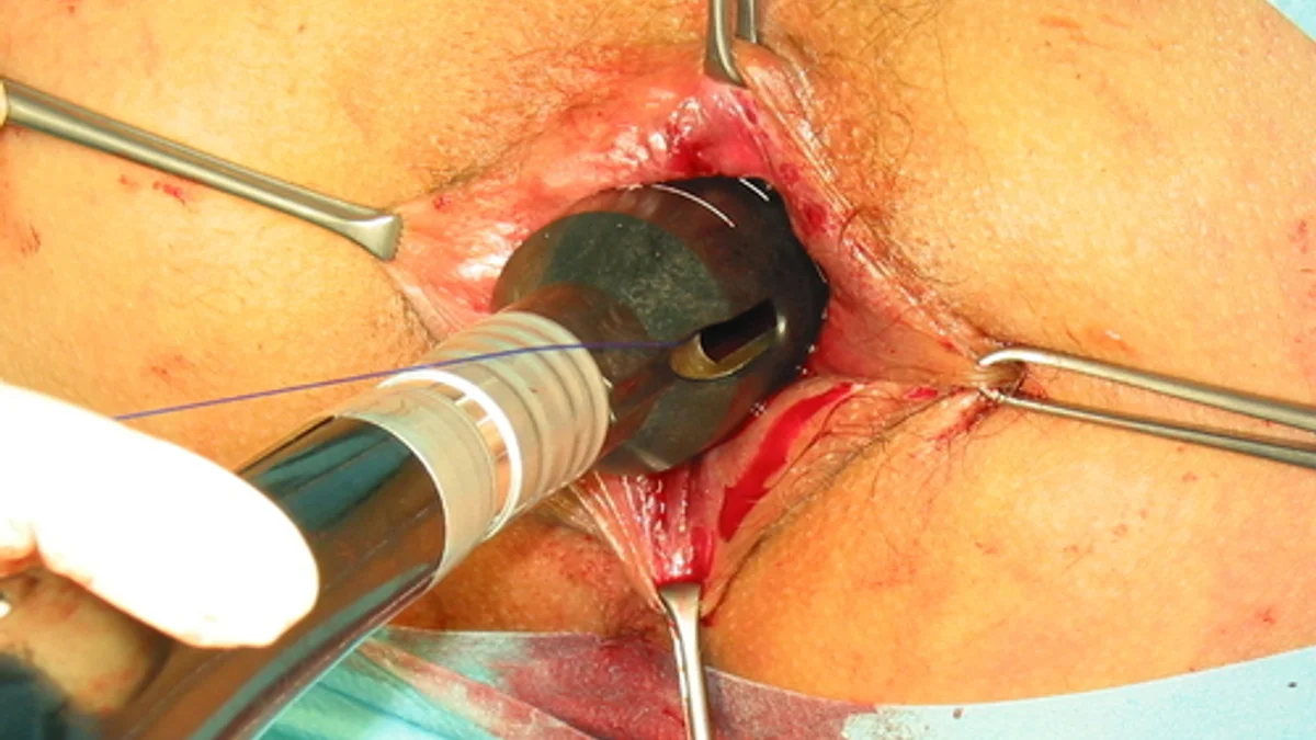 Quack's Dangerous Piles Remedy Goes Wrong: 1.5 Kg Hot Stone Gets Stuck Inside Patient's Body