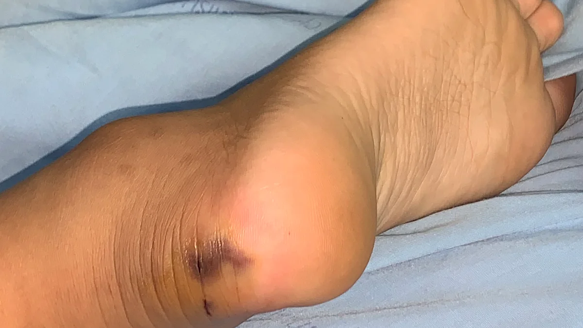 भारत में बढ़ते सांप के काटने के मामलों ने बढ़ाई चिंता, बचाव और इलाज के लिए जानिए जरूरी बातें